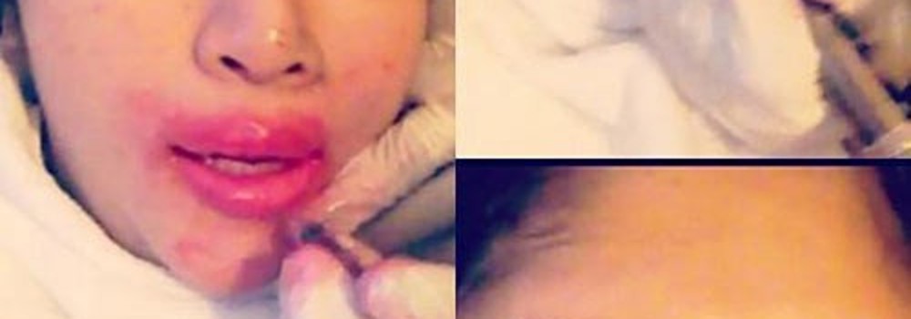 10 năm thở bằng miệng do 6 lần nâng mũi