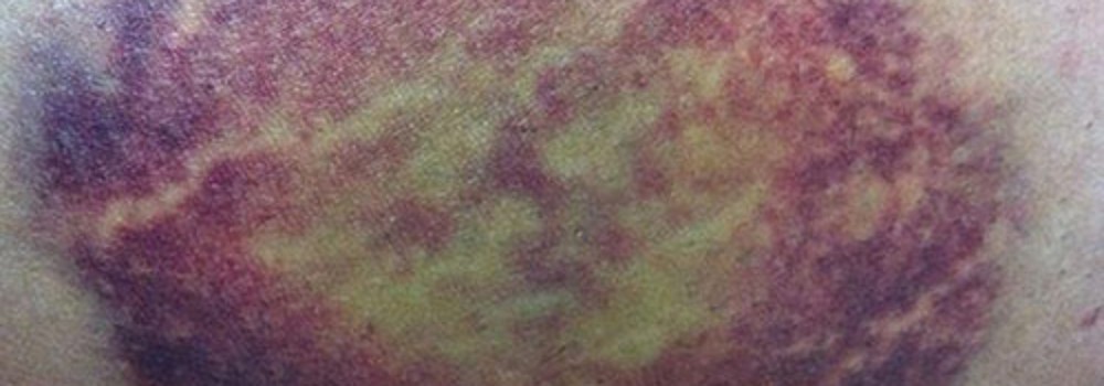 Cảnh giác với nốt bầm tím trên cơ thể: Có thể là dấu hiệu bệnh nguy hiểm