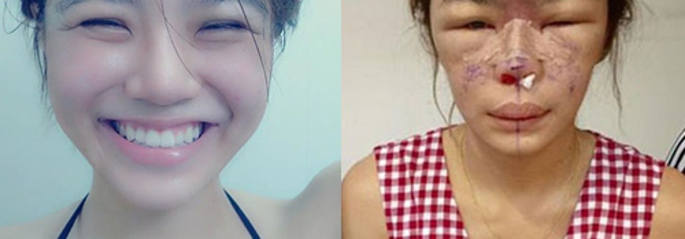 Mặt sưng vù, chảy dịch vì thẩm mỹ cho đúng phong thuỷ