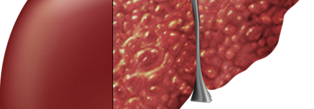 Những biện pháp giúp tầm soát sớm ung thư gan