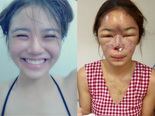 Mặt sưng vù, chảy dịch vì thẩm mỹ cho đúng phong thuỷ