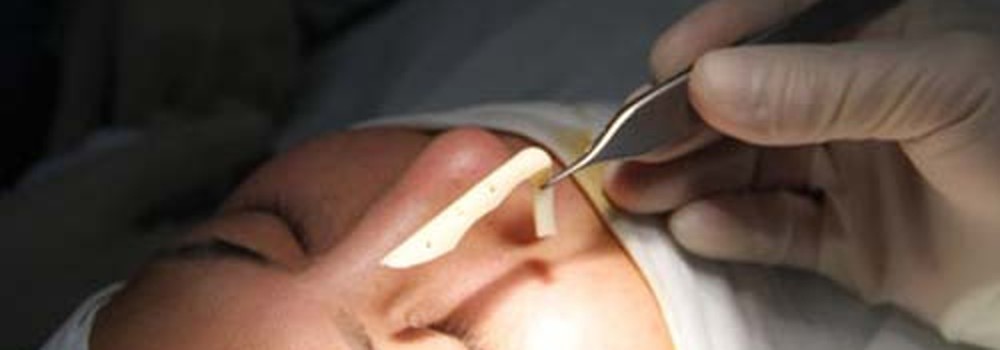 Nâng mũi bằng sụn tai: Có ngày “mất mặt”, mất mũi