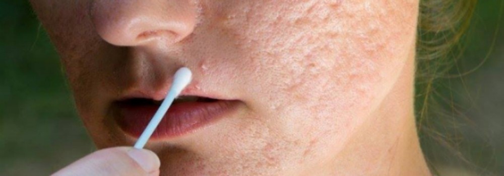 Sẹo rỗ và những dạng biến thể cấu trúc thường gặp