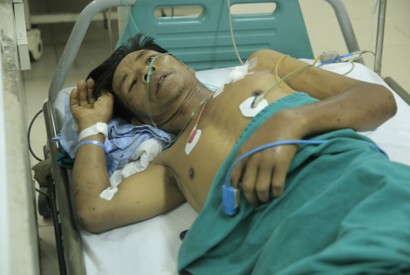 Một người nguy kịch vì nhiễm khuẩn liên cầu lợn