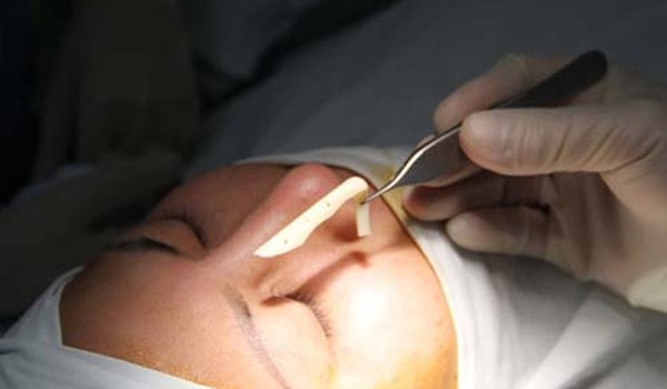 ការ​វះកាត់​ឆ្អឹង​ត្រចៀក​ដោយ​ឆ្អឹង​ខ្ចី​៖ ថ្ងៃ​មួយ​អ្នក​«​បាត់​មុខ​» និង​បាត់​ច្រមុះ​